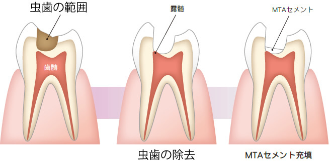 正確な診断の元、歯の神経を守る「歯髄保存療法」に力を入れています！