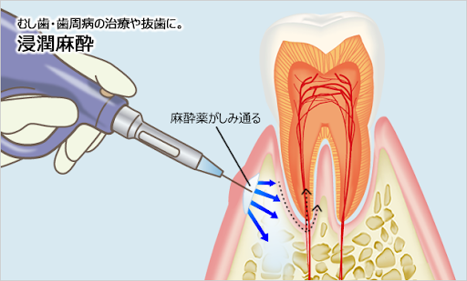 電動麻酔器