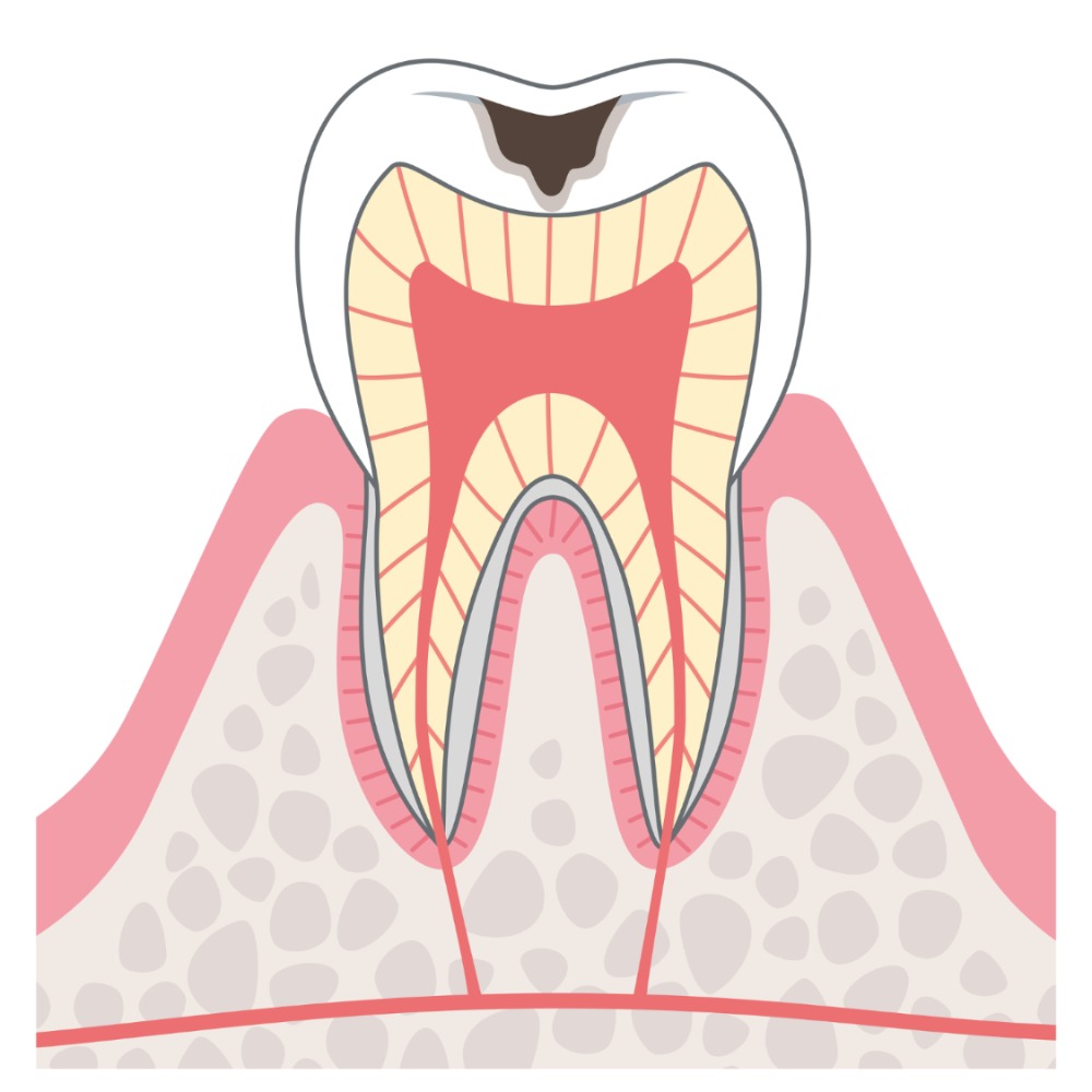 C2象牙質のむし歯
