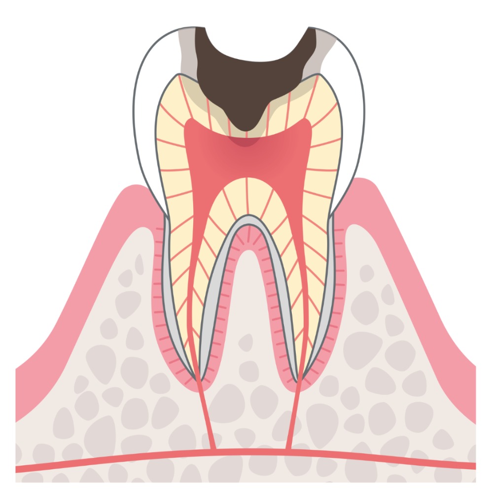 C3歯髄付近に到達したむし歯