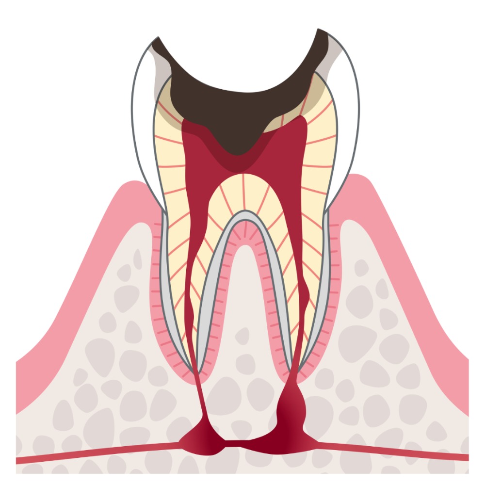 C4歯根まで進んだむし歯