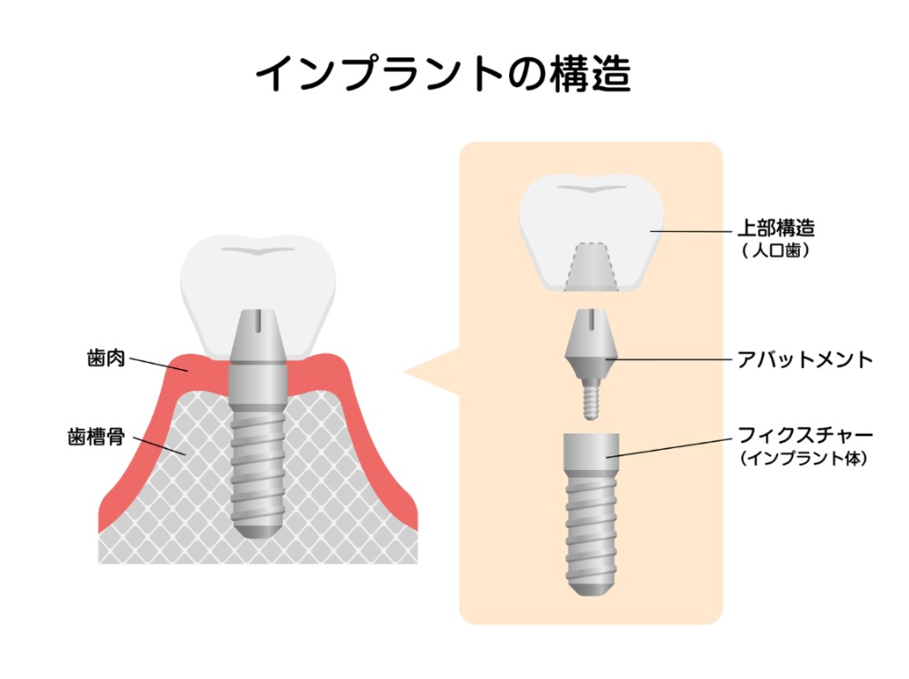 インプラント治療とは？