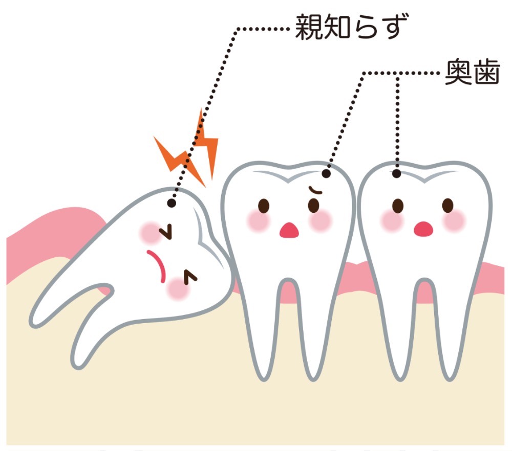 親知らずでお悩みの方