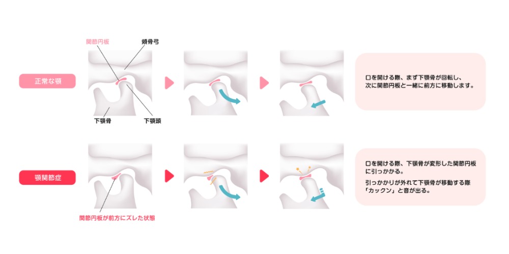 顎関節症でお悩みの方