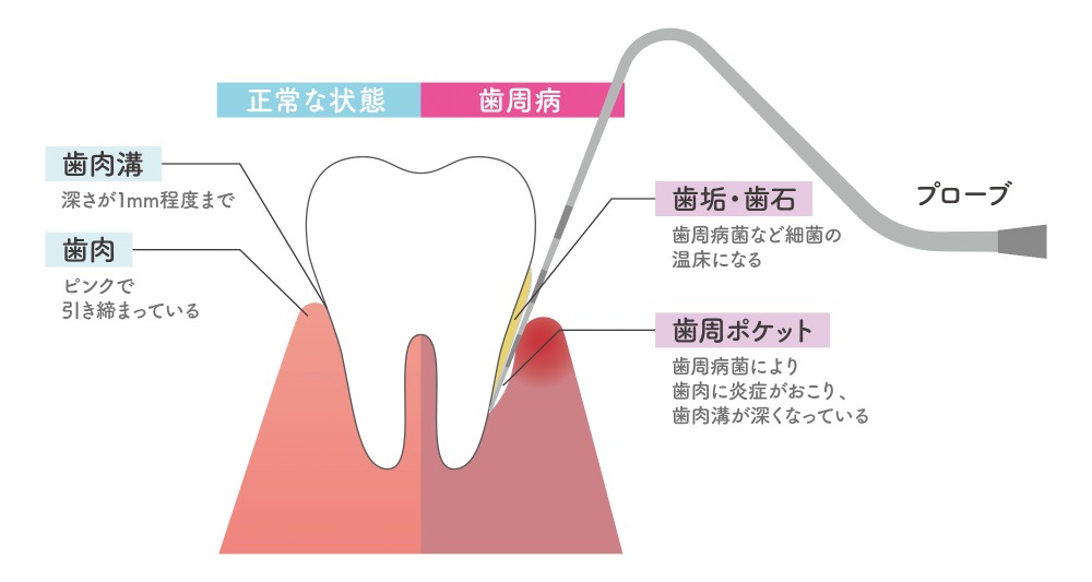 歯を失う原因第１位の「歯周病」
