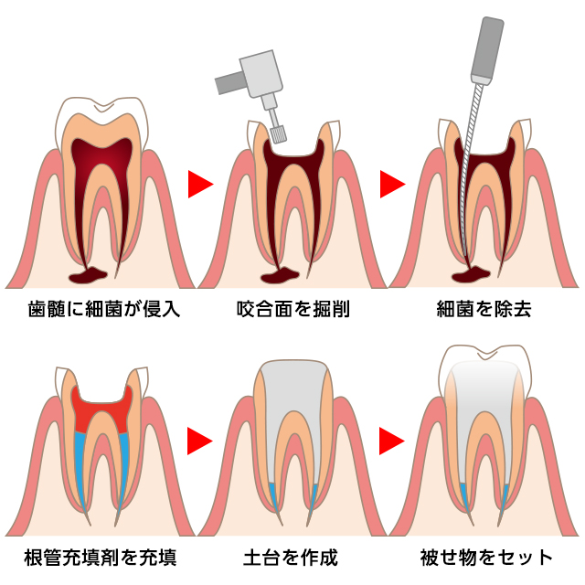 そもそも根管治療とは？